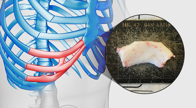 Autologous Rib Cartilage