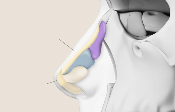 Nasal Tip (Autologous Rib Cartilage) + Nasal Bridge (Autologous Rib Cartilage)