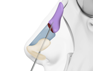 03. Periosteum Dissection on the Nasal Bone