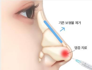 06. 늑연골을 이용한 비중격 재건