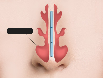 03. 수술 후