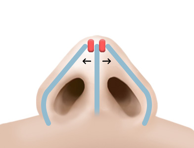 03. 수술 후