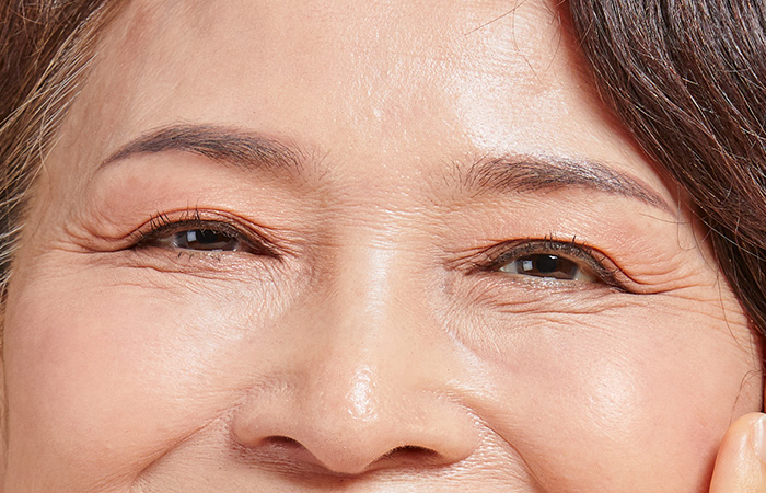 Subbrow Lift