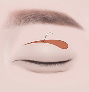 03. 절개 부위 통합