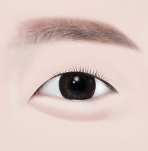 04. 수술 마무리
