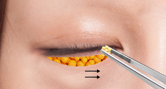 03. Fat Repositioning