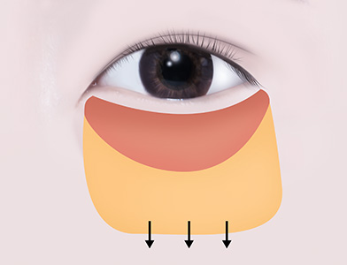 03. 눈둘레근하지방 박리