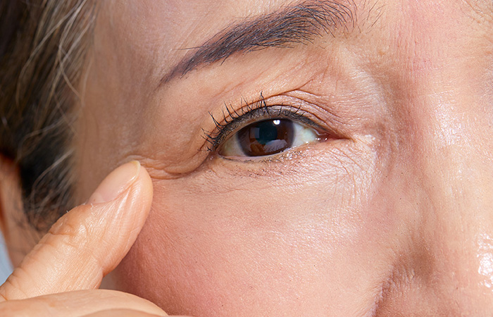 Lower eyelid, Face lift